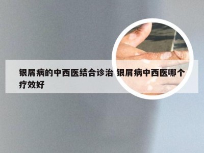 银屑病的中西医结合诊治 银屑病中西医哪个疗效好