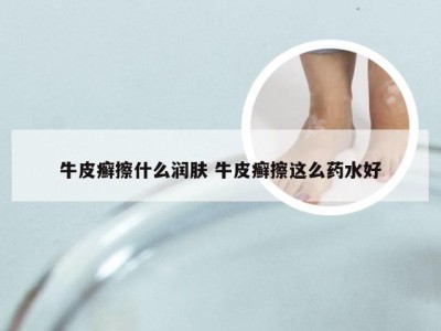 牛皮癣擦什么润肤 牛皮癣擦这么药水好