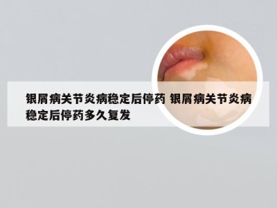 银屑病关节炎病稳定后停药 银屑病关节炎病稳定后停药多久复发