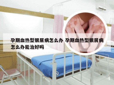 孕期血热型银屑病怎么办 孕期血热型银屑病怎么办能治好吗