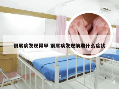 银屑病发现得早 银屑病发现前期什么症状