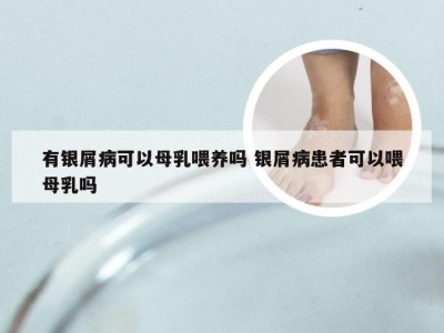 有银屑病可以母乳喂养吗 银屑病患者可以喂母乳吗