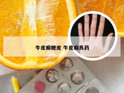 牛皮癣糖皮 牛皮癣良药