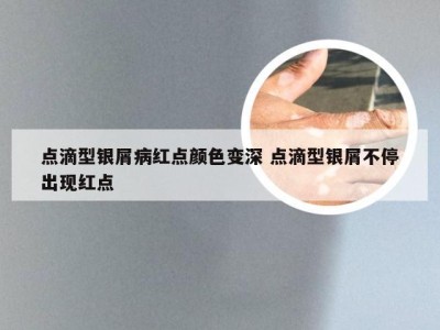 点滴型银屑病红点颜色变深 点滴型银屑不停出现红点