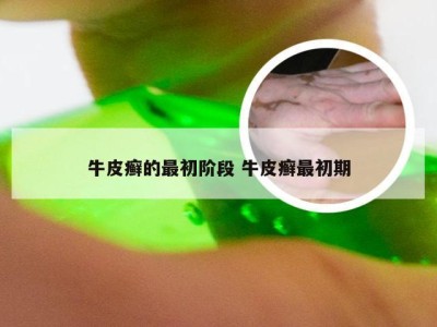 牛皮癣的最初阶段 牛皮癣最初期