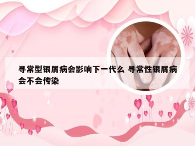 寻常型银屑病会影响下一代么 寻常性银屑病会不会传染