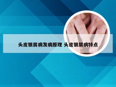 头皮银屑病发病原理 头皮银屑病特点