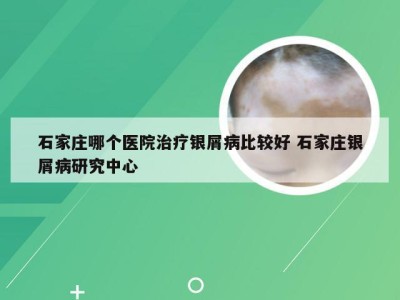 石家庄哪个医院治疗银屑病比较好 石家庄银屑病研究中心