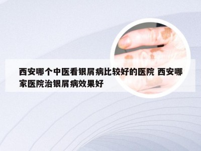 西安哪个中医看银屑病比较好的医院 西安哪家医院治银屑病效果好