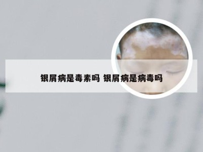 银屑病是毒素吗 银屑病是病毒吗