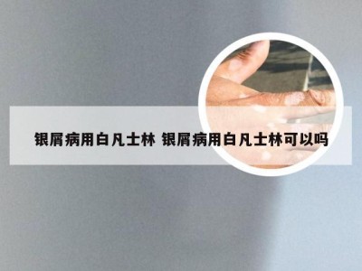 银屑病用白凡士林 银屑病用白凡士林可以吗