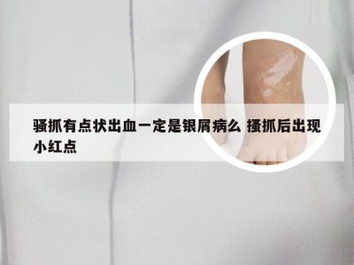 骚抓有点状出血一定是银屑病么 搔抓后出现小红点