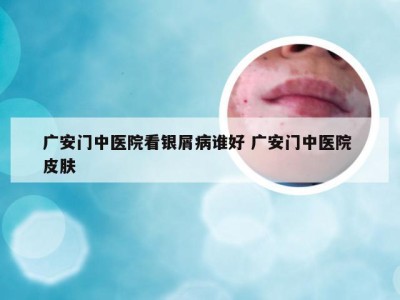 广安门中医院看银屑病谁好 广安门中医院 皮肤