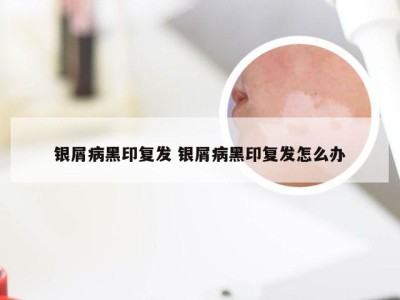 银屑病黑印复发 银屑病黑印复发怎么办