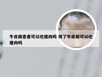 牛皮癣患者可以吃猪肉吗 得了牛皮癣可以吃猪肉吗