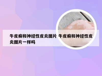 牛皮癣和神经性皮炎图片 牛皮癣和神经性皮炎图片一样吗