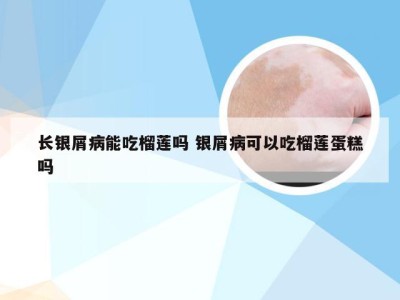 长银屑病能吃榴莲吗 银屑病可以吃榴莲蛋糕吗