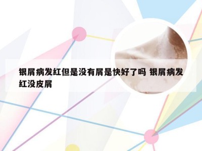 银屑病发红但是没有屑是快好了吗 银屑病发红没皮屑