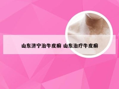 山东济宁治牛皮癣 山东治疗牛皮癣