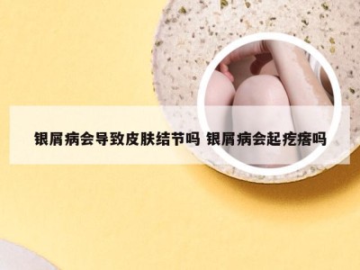 银屑病会导致皮肤结节吗 银屑病会起疙瘩吗