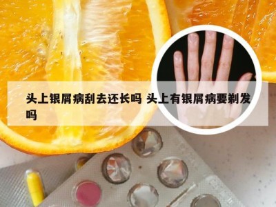 头上银屑病刮去还长吗 头上有银屑病要剃发吗