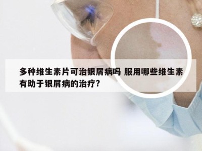 多种维生素片可治银屑病吗 服用哪些维生素有助于银屑病的治疗?