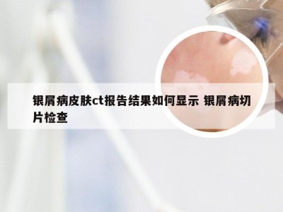 银屑病皮肤ct报告结果如何显示 银屑病切片检查