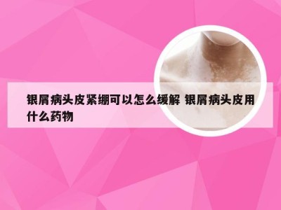 银屑病头皮紧绷可以怎么缓解 银屑病头皮用什么药物