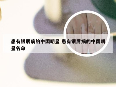 患有银屑病的中国明星 患有银屑病的中国明星名单