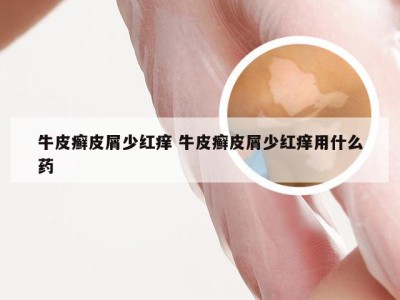 牛皮癣皮屑少红痒 牛皮癣皮屑少红痒用什么药