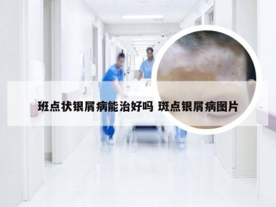班点状银屑病能治好吗 斑点银屑病图片