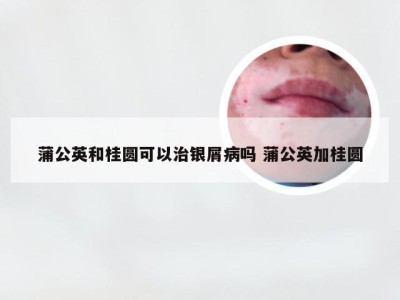 蒲公英和桂圆可以治银屑病吗 蒲公英加桂圆