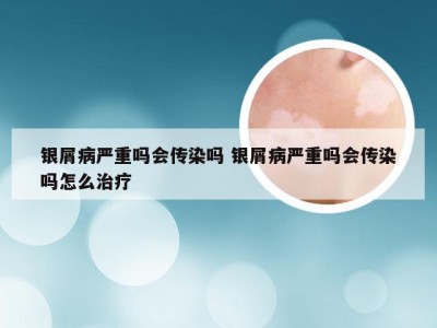 银屑病严重吗会传染吗 银屑病严重吗会传染吗怎么治疗