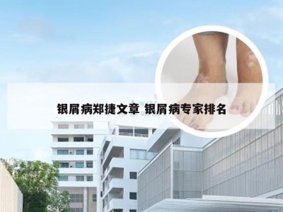 银屑病郑捷文章 银屑病专家排名