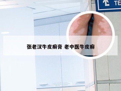 张老汉牛皮癣膏 老中医牛皮癣