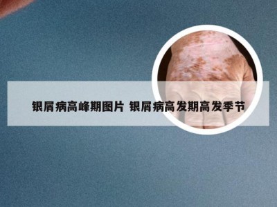 银屑病高峰期图片 银屑病高发期高发季节