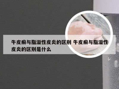 牛皮癣与脂溢性皮炎的区别 牛皮癣与脂溢性皮炎的区别是什么