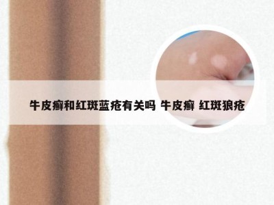 牛皮癣和红斑蓝疮有关吗 牛皮癣 红斑狼疮