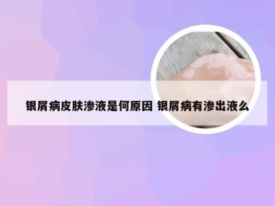 银屑病皮肤渗液是何原因 银屑病有渗出液么