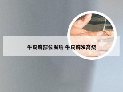 牛皮癣部位发热 牛皮癣发高烧