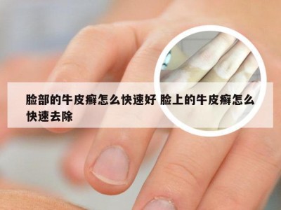 脸部的牛皮癣怎么快速好 脸上的牛皮癣怎么快速去除