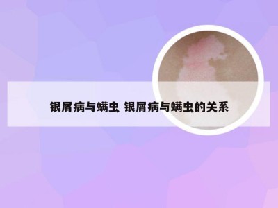 银屑病与螨虫 银屑病与螨虫的关系