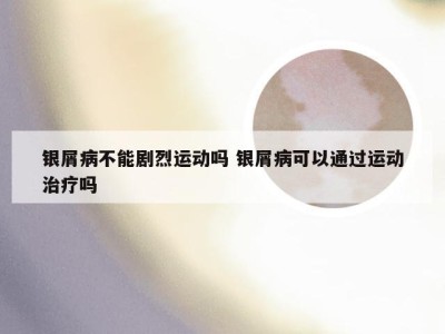 银屑病不能剧烈运动吗 银屑病可以通过运动治疗吗