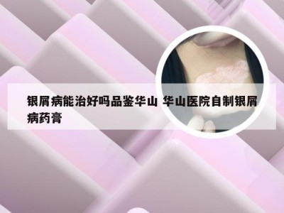 银屑病能治好吗品鉴华山 华山医院自制银屑病药膏
