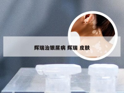 辉瑞治银屑病 辉瑞 皮肤