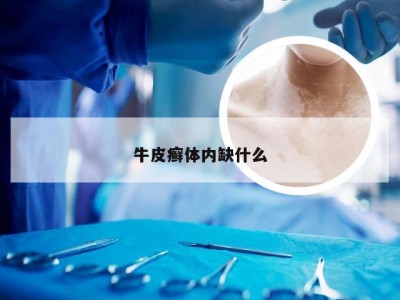 牛皮癣体内缺什么