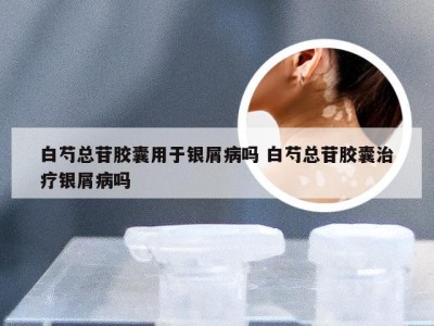 白芍总苷胶囊用于银屑病吗 白芍总苷胶囊治疗银屑病吗