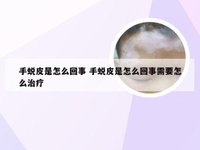 手蜕皮是怎么回事 手蜕皮是怎么回事需要怎么治疗