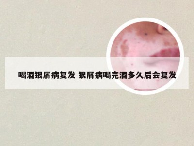 喝酒银屑病复发 银屑病喝完酒多久后会复发