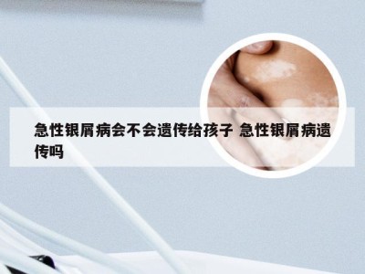 急性银屑病会不会遗传给孩子 急性银屑病遗传吗